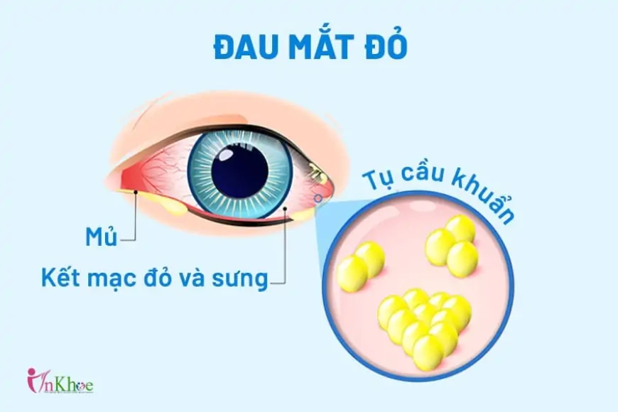 Bệnh đau mắt đỏ là gì? Dấu hiệu, nguyên nhân và lưu ý